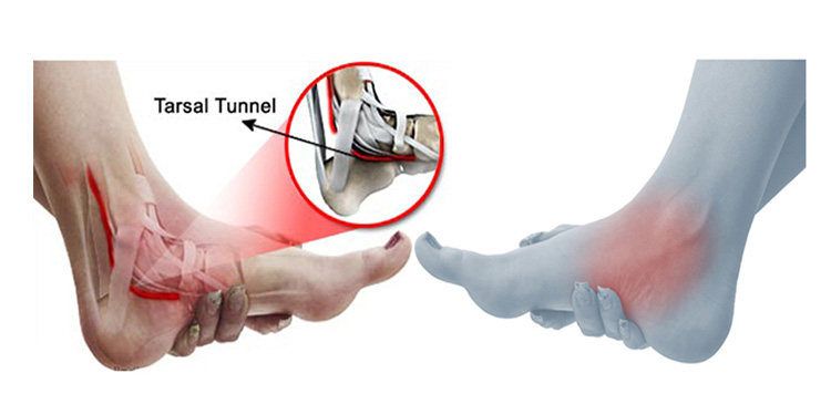 Tarsal Tünel Sendromu