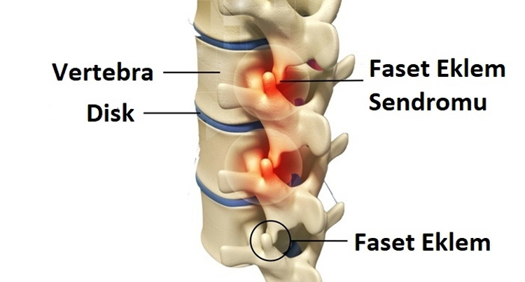 Faset Sendromu Tedavisi