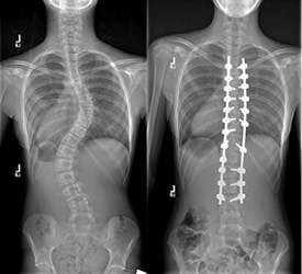 Skolyozun Cerrahi Tedavisi